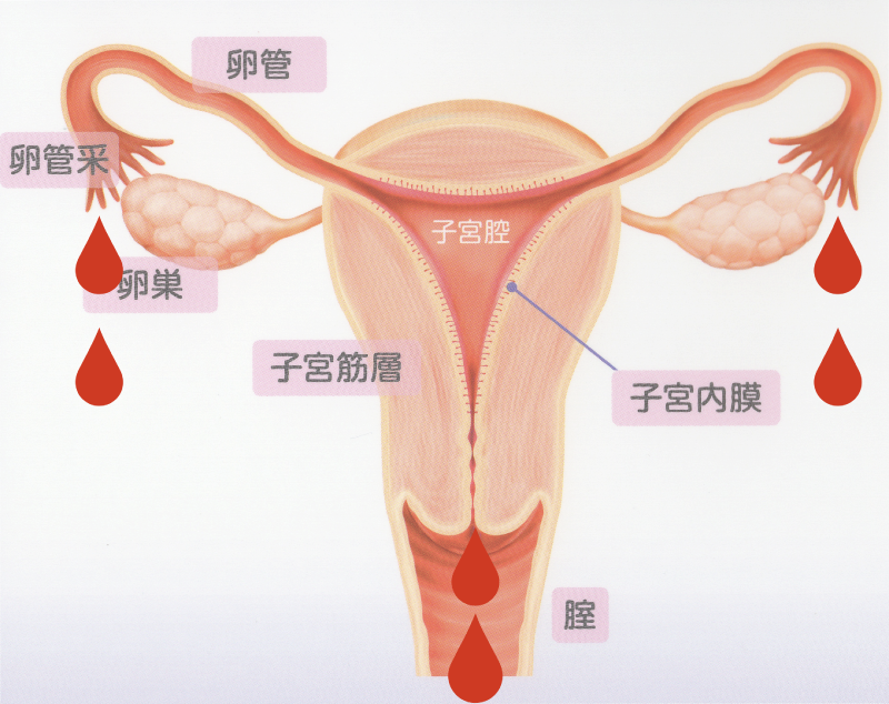 経血の一部は、卵管を通って腹腔にも逆流します。