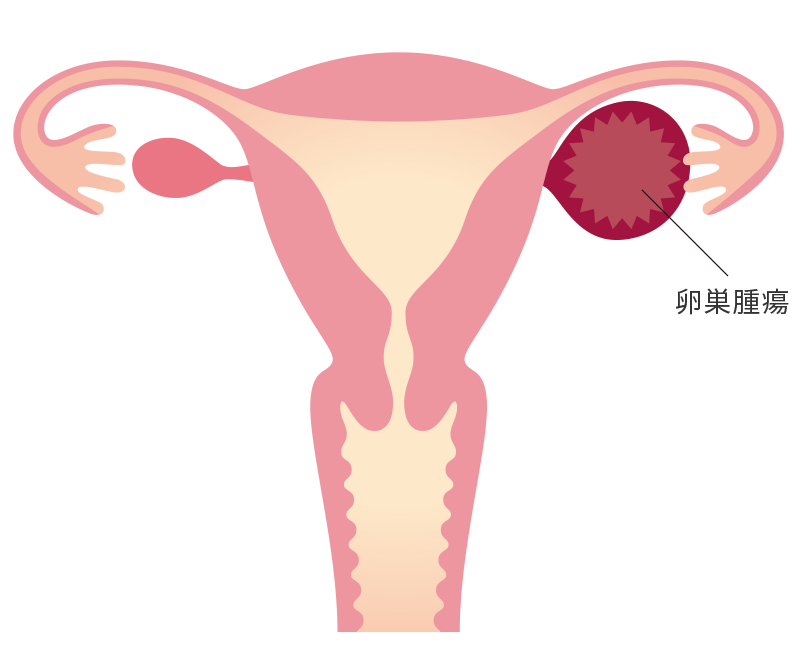 卵巣腫瘍のイメージ